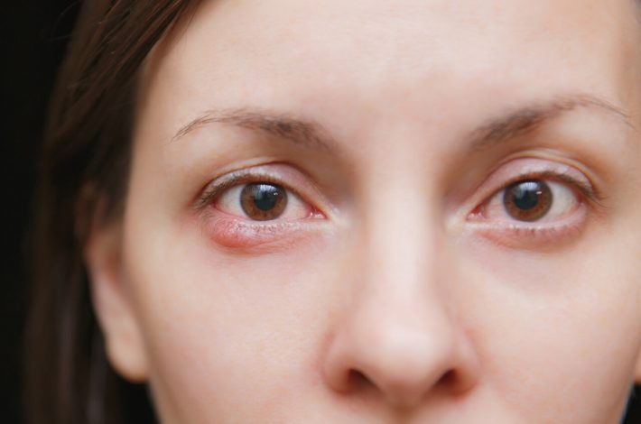 woman with stye